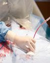 MANIPAL HOSPITAL GOA PERFORMS REGION'S FIRST ROTA-PRO ANGIOPLASTY ON 84-YEAR-OLD PATIENT0