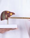 FATTY LIVER: THE SILENT DISEASE RISING WITH MODERN LIFESTYLE28