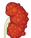 CUREator backs Monash biotech to advance new therapeutics for polycystic kidney disease14