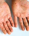 PAHO intensifies call to strengthen vaccination in light of rising measles cases17