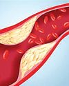 IASST designs optical sensing platform for detecting cholesterol
