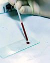Researchers in Nashik develop blood test to detect 30 types of cancer