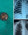 Button battery removed from a 4-year-old's bronchus