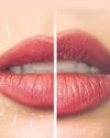 UORFI JAVED'S LIP FILLER REVERSAL: EXPERTS WEIGH IN63
