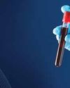Indian-made gene therapy for blood cancer shows 73% response rate in clinical trials Indian-made gene therapy for blood cancer shows 73% response rate in clinical trials