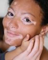 Vitiligo, Penyakit Kulit yang Diduga Diidap Jokowi Tak Dapat Disembuhkan32