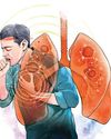 Lung cancer among non-smokers up, says Lancet