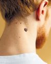 De-mystifying skin tags De-mystifying skin tags