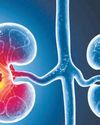 Kidney cancer's genetic connection Kidney cancer's genetic connection83