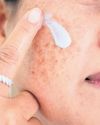 The Manifolds of Melasma Recurrence75