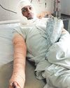 पीआईएल फर्नेश ब्लास्ट में एक और मजदूर की मौत0