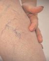 Ice-cold feet and heaviness in legs? It may signal varicose veins, says study Ice-cold feet and heaviness in legs? It may signal varicose veins, says study