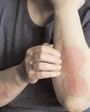 Study shows why psoriasis patients may be at risk of obesity, fatty liver disease Study shows why psoriasis patients may be at risk of obesity, fatty liver disease