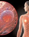 Australian researchers launch pioneering trial targeting untreatable cancers44