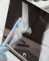 Indian researchers develop diagnostic device to detect early-stage bone cancer35