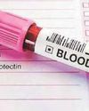Prostate cancer hope for at-home spit tests Prostate cancer hope for at-home spit tests