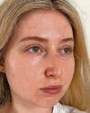 Can red light heal my acne scars?41