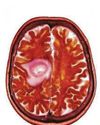 Personalised care plans for young brain cancer patients Personalised care plans for young brain cancer patients29