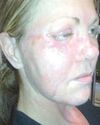 'Antibiotic-resistant infection ate my face after crash'19