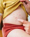 NHS offers chickenpox jabs to protect children20