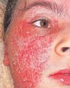 Woman's battle with medics over agonising skin condition16