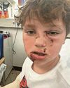 Eight-year-old boy 'recovering well' from surgery after horror dog attack Eight-year-old boy 'recovering well' from surgery after horror dog attack