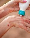 How to spot, treat, and prevent scabies How to spot, treat, and prevent scabies