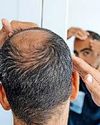 KEEP YOUR HAIR ON.. BALDIE CURE ON WAY KEEP YOUR HAIR ON.. BALDIE CURE ON WAY25