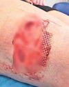 Dog attack in street left my teenage daughter needing surgery Dog attack in street left my teenage daughter needing surgery5