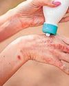 How to spot, treat and prevent scabies How to spot, treat and prevent scabies