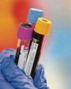 Blood test offers hope of detecting Alzheimer's in patients quicker and easier11