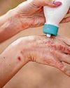 How to spot, treat, and prevent scabies How to spot, treat, and prevent scabies
