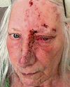 Gran left 'unrecognisable' after nap in the sun3