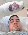 Sleepwalker wakes with 45 stitches in his hand Sleepwalker wakes with 45 stitches in his hand