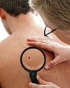 Trials over skin cancer vaccine are due to start Trials over skin cancer vaccine are due to start