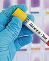 Alzheimer's blood test can measure disease's progress22
