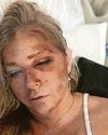 Cops deny Giuffre’s ‘injuries’30