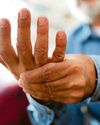 Huge toll of arthritis in Scotland is spelled out24