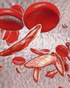 New drug ‘cure’ hope for sickle cell Scots14