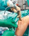 TOTAL ELBOW REPLACEMENT TOTAL ELBOW REPLACEMENT