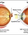 THE ROLE OF OUTDOOR EXPOSURE IN MYOPIA PREVENTION: WHAT DOES SCIENCE SAY?