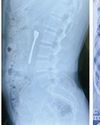 Man swallows spoon, rare surgery performed to remove it from stomach35