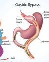 The Silent Surgical Risk: Understanding Visceral Fat and the Role of Bariatric Surgery72