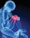 Why women get osteoarthritis more often Why women get osteoarthritis more often64