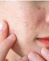 Don’t Ignore Post-Holi Skin Reactions: Expert Advice for Quick Recovery75