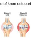 The early warning signs of joint degeneration that are often overlooked The early warning signs of joint degeneration that are often overlooked70