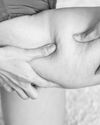 Lipoedema: A Lesser-Known Chronic Leg Fat Condition21