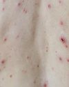 ‘Give children chickenpox jabs to beat anti-vaxxers’6