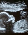 Radiographers sound alarm over high street baby scans5