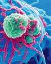 GI cancers rising among middle-aged adults9